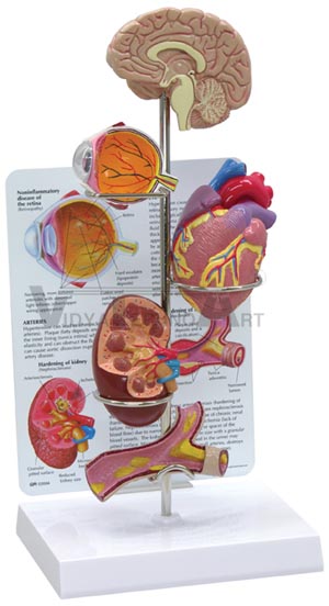 Hypertension Model Set